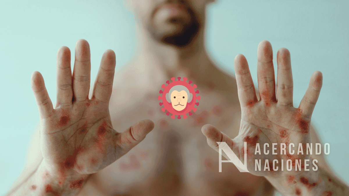 Viruela del mono, alerta sanitaria y recomendaciones